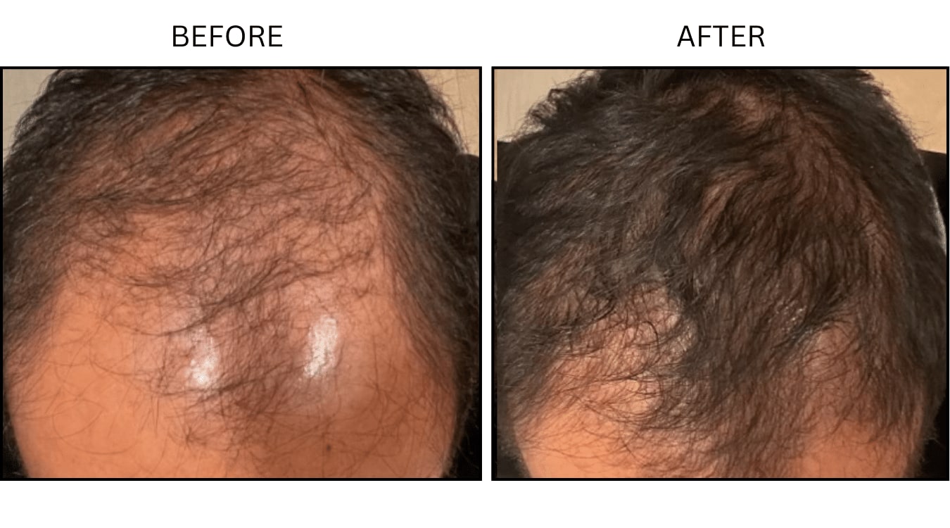 Hair Loss (Medical), before and after photograph 10
