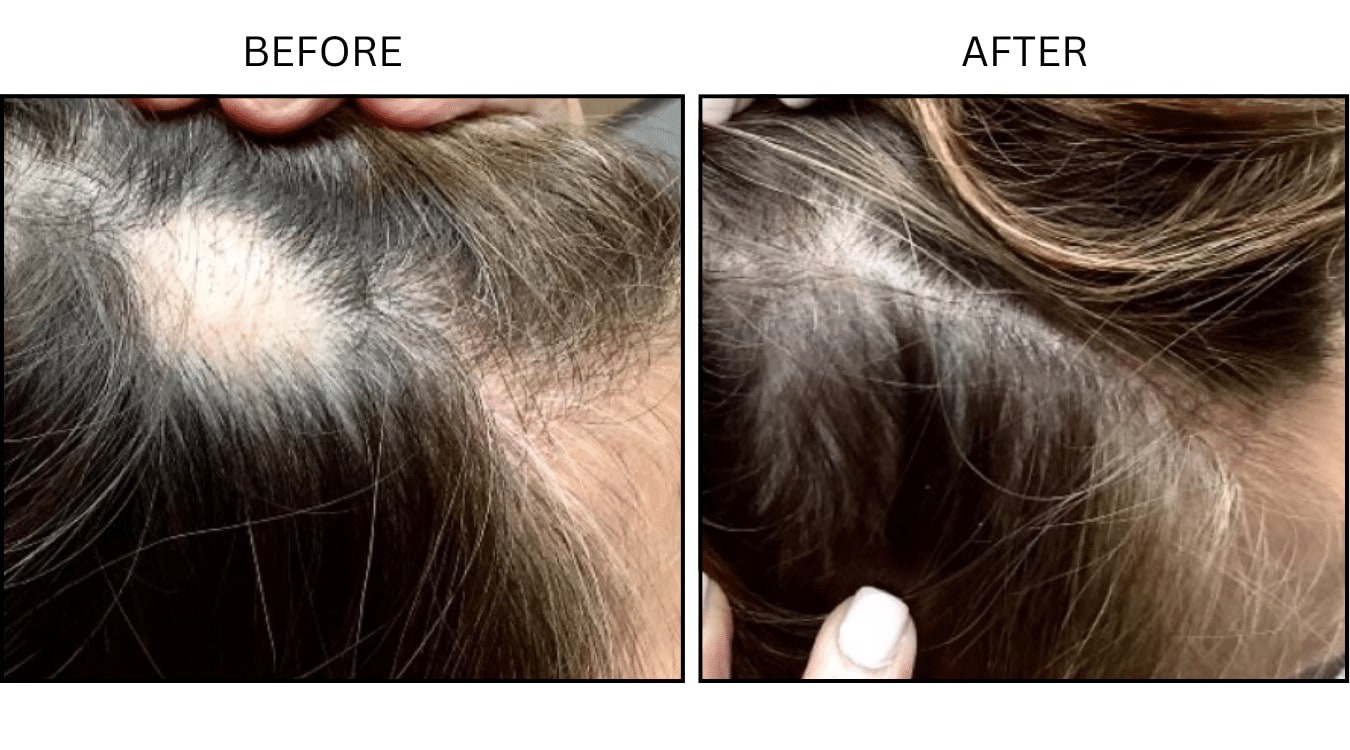 Hair Loss (Medical), before and after photograph 11