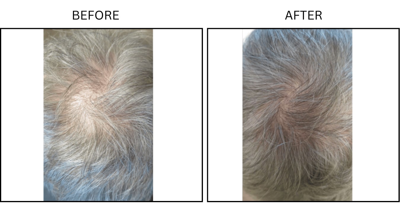 Hair (male) (PRP), before and after photograph 1