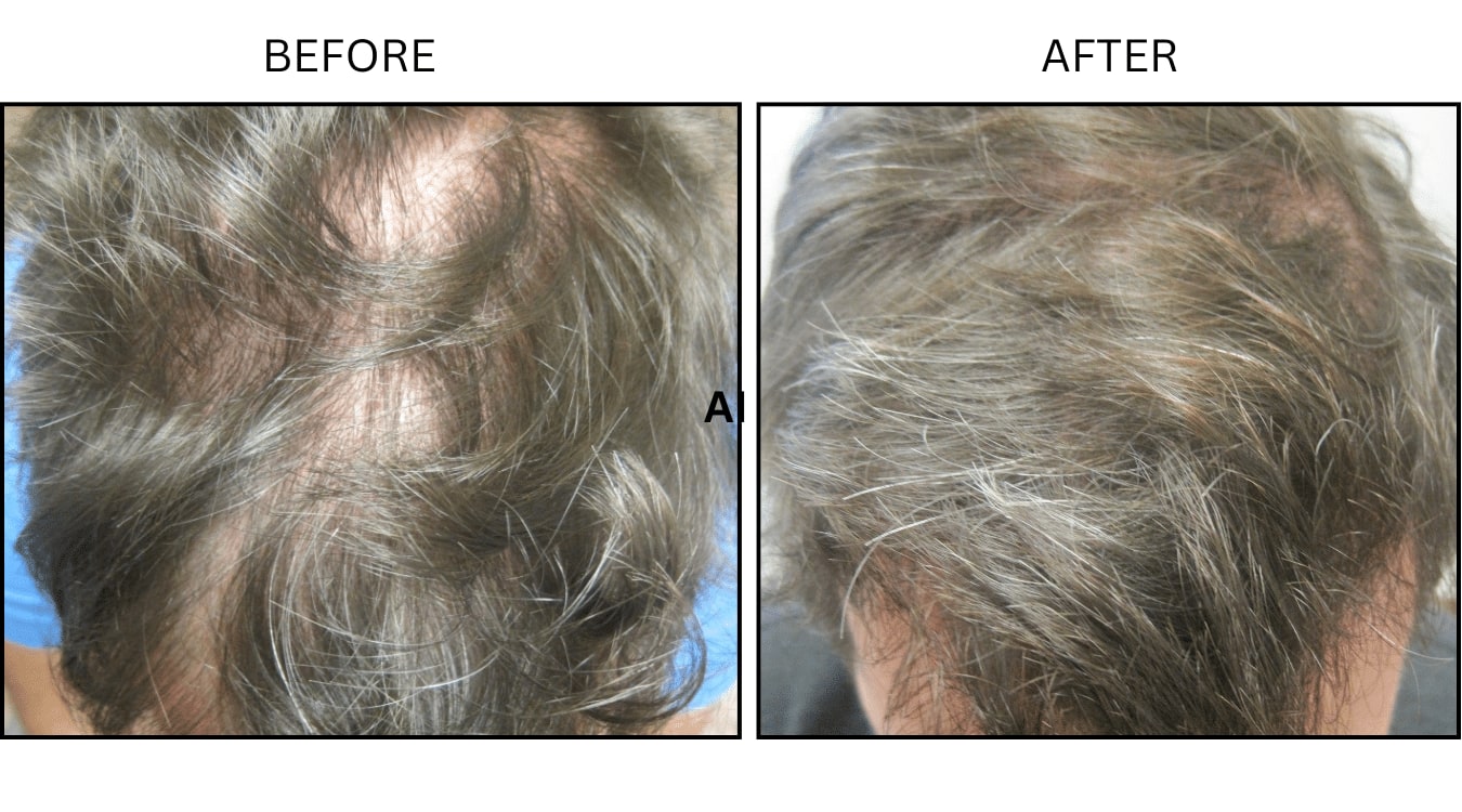 Hair (male) (PRP), before and after photograph 2