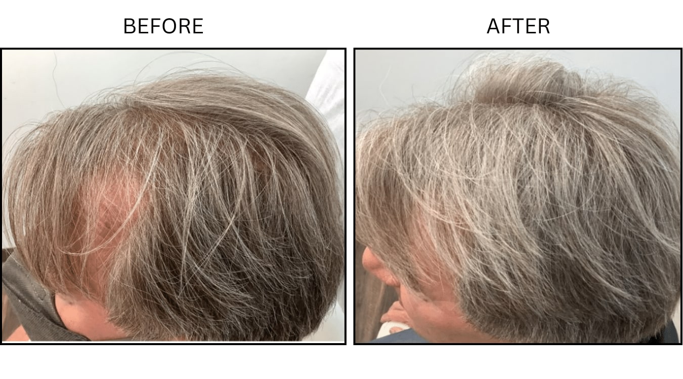 Hair (male) (PRP), before and after photograph 3