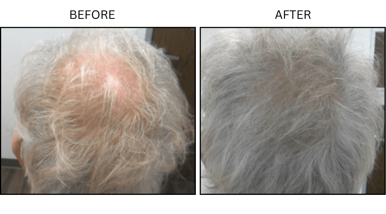 Hair (male) (PRP), before and after photograph 4
