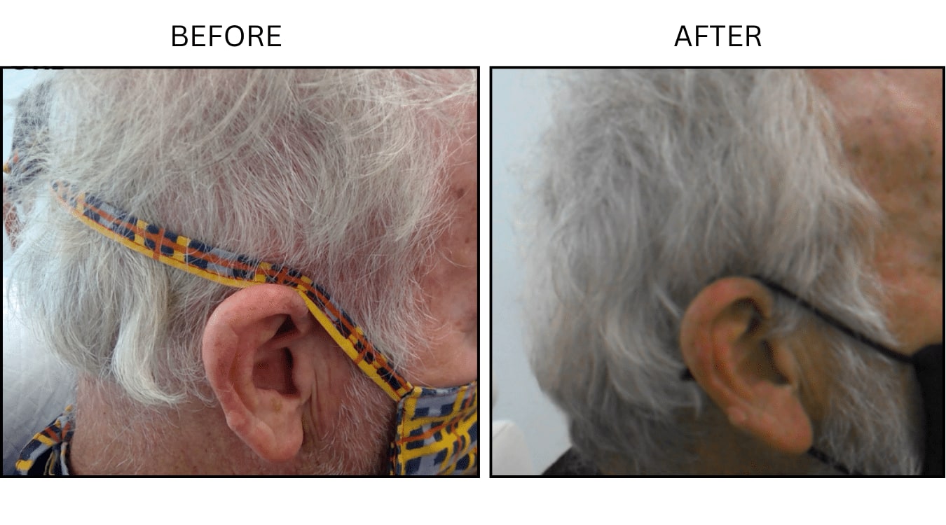 Hair (male) (PRP), before and after photograph 5