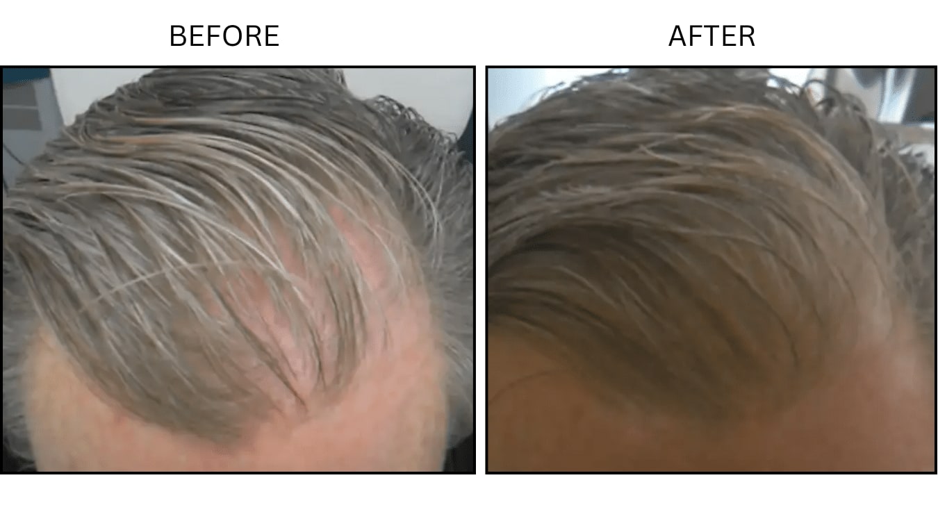 Hair (male) (PRP), before and after photograph 6