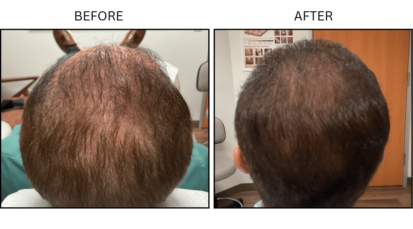 Hair (male) (PRP), before and after photograph 7