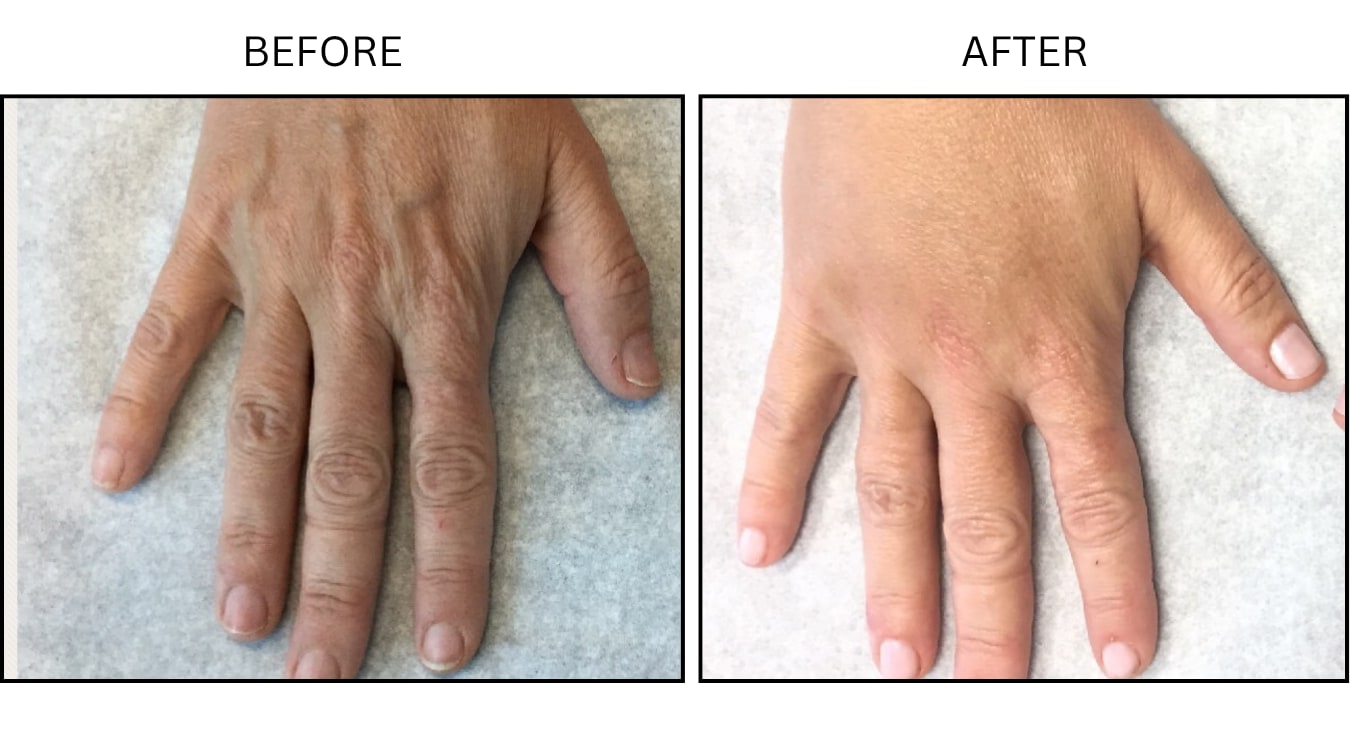 Hands (Fillers), before and after photograph 3