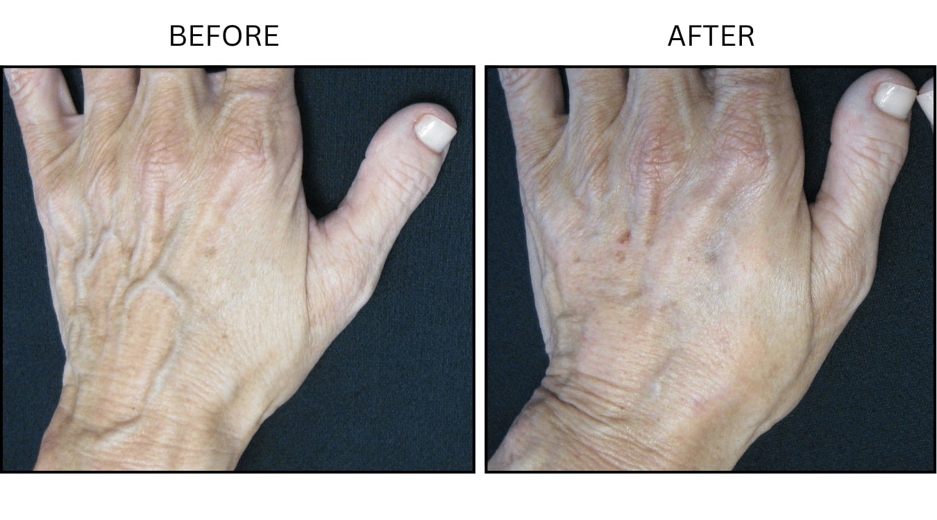 Hands (Fillers), before and after photograph 1