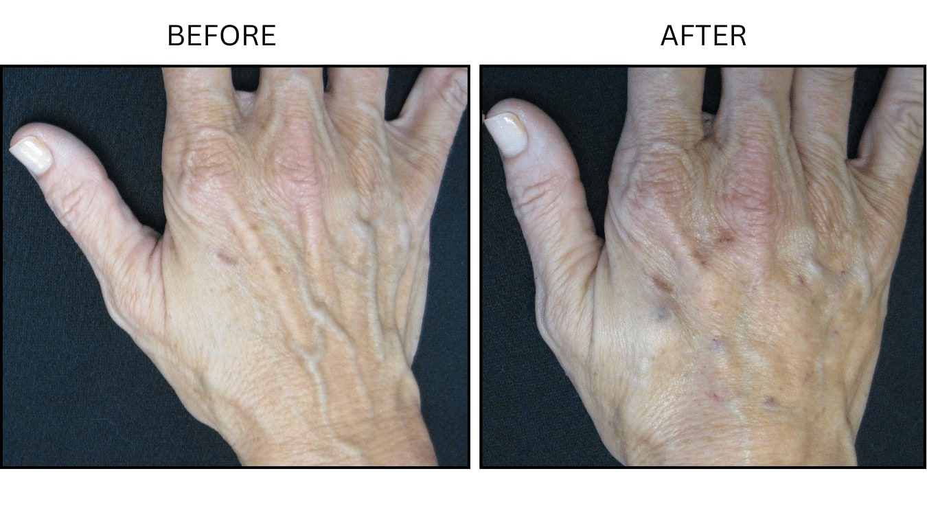 Hands (Fillers), before and after photograph 2