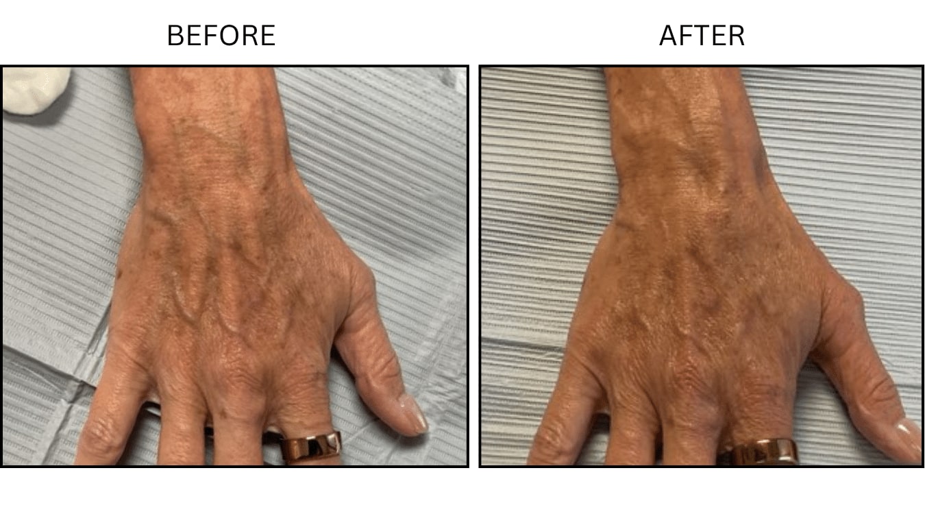 Hands (Fillers), before and after photograph 4