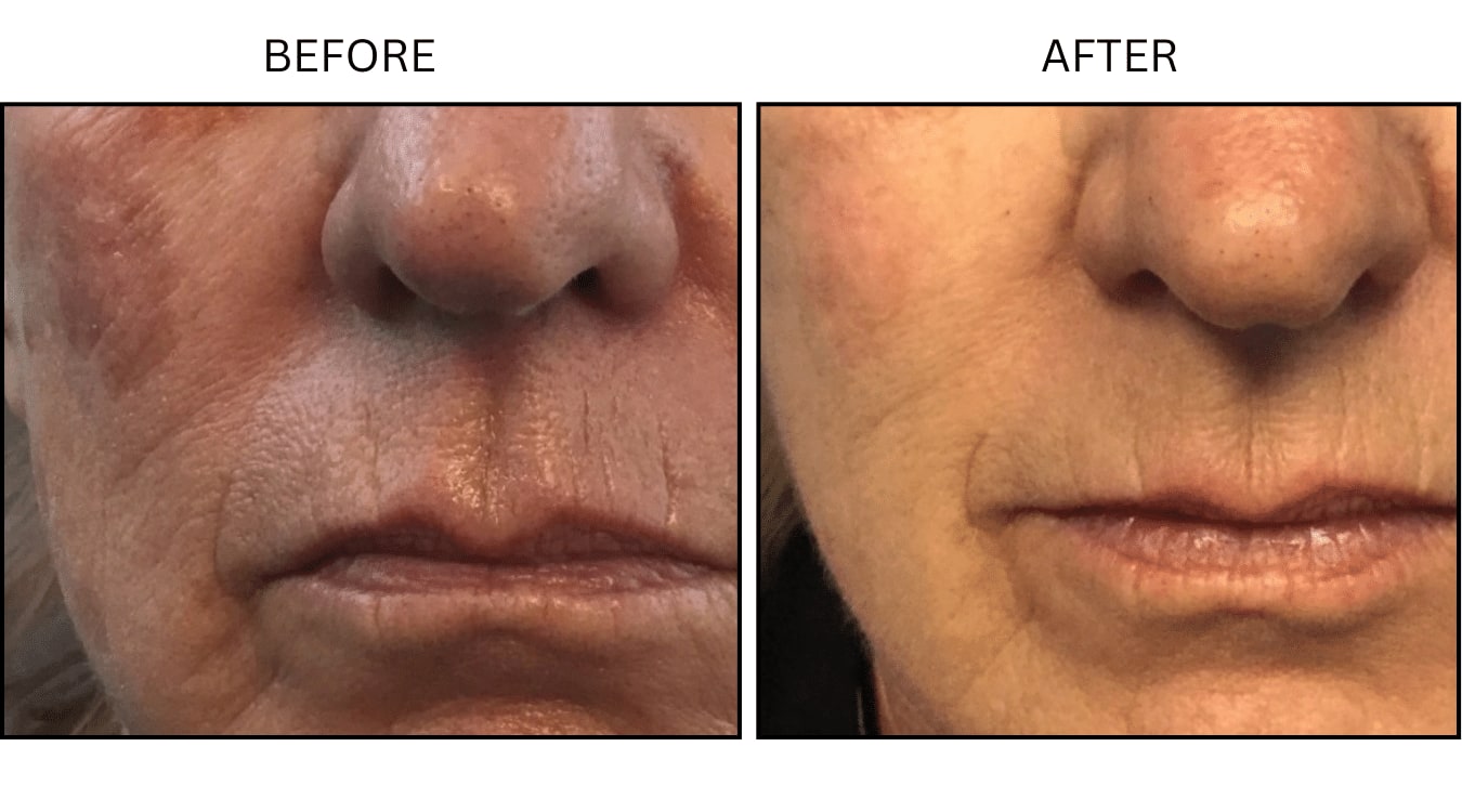 IPL (Lasers), before and after photograph 13
