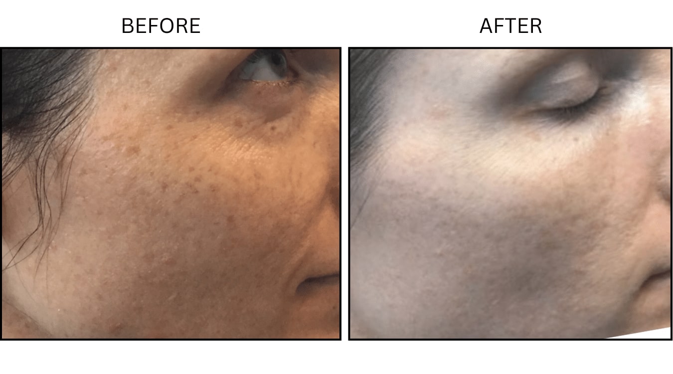 IPL (Lasers), before and after photograph 14