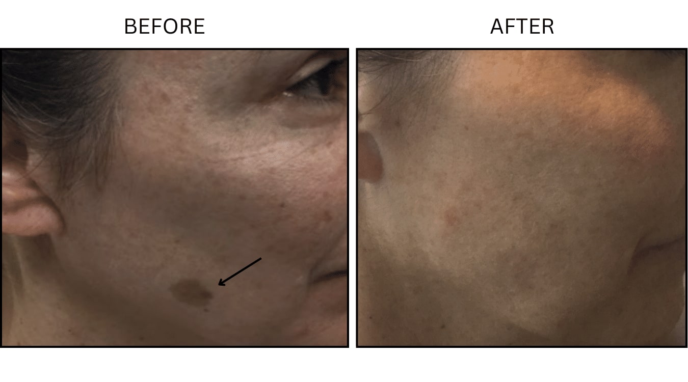 IPL (Lasers), before and after photograph 15