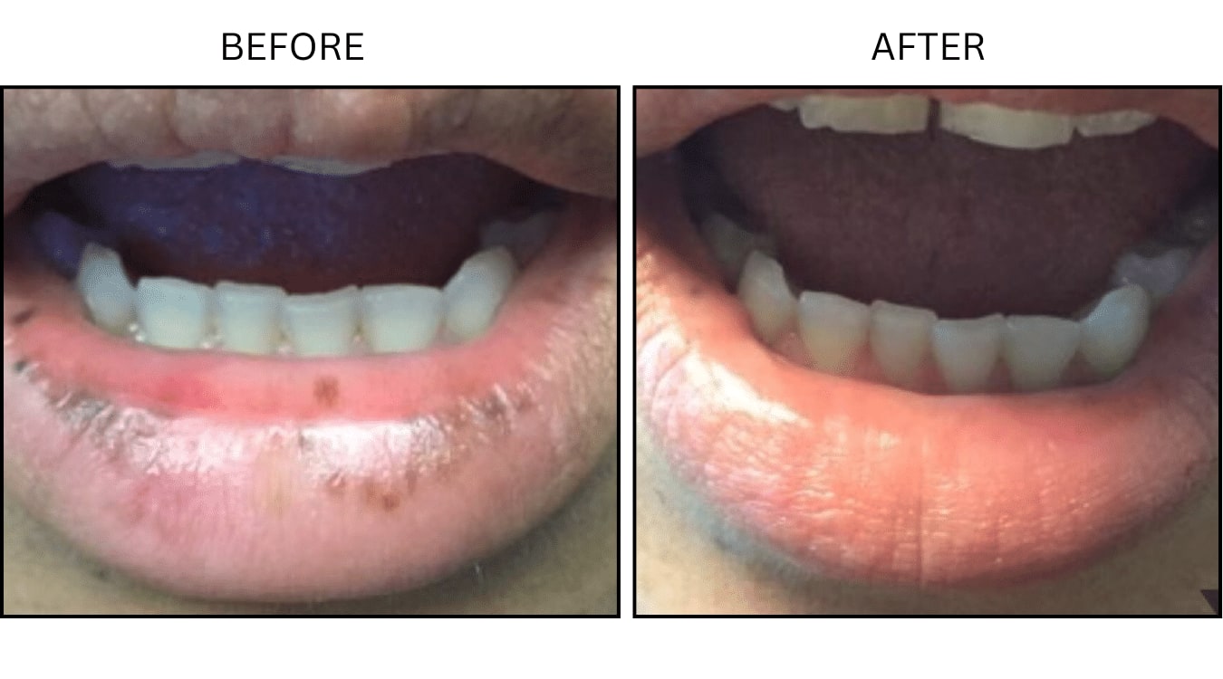 IPL (Lasers), before and after photograph 16