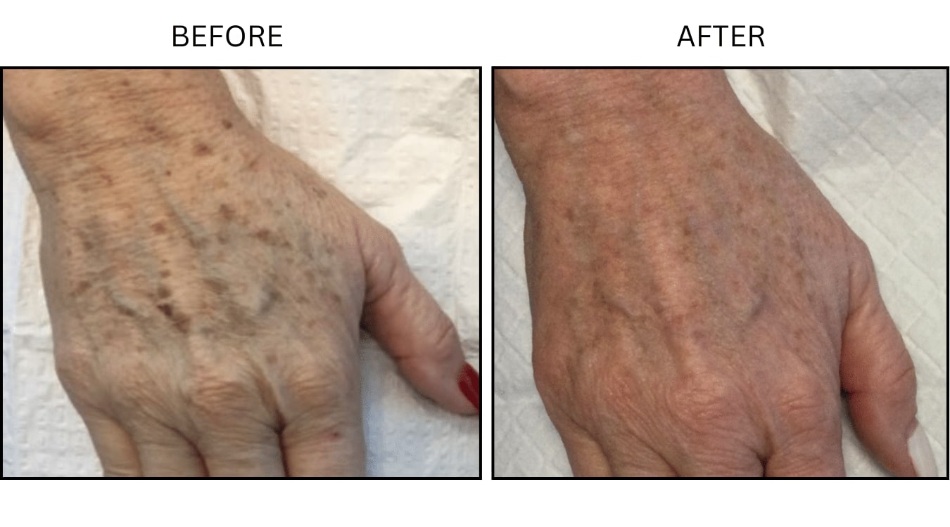 IPL (Lasers), before and after photograph 9