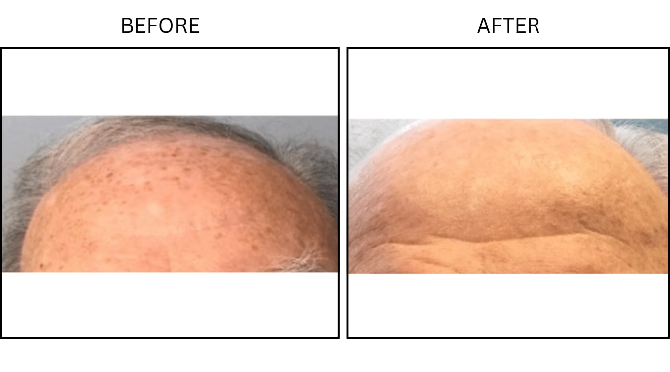 IPL (Lasers), before and after photograph 10