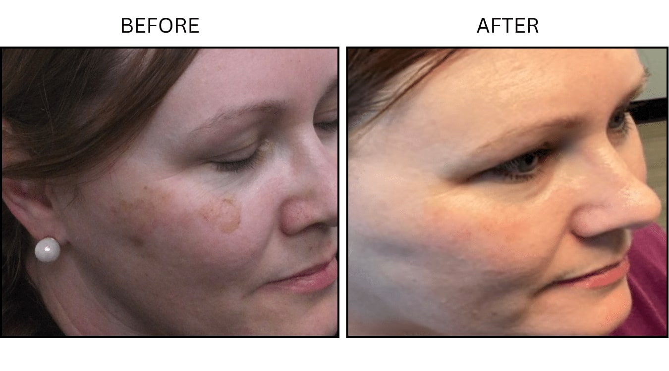 IPL (Lasers), before and after photograph 11