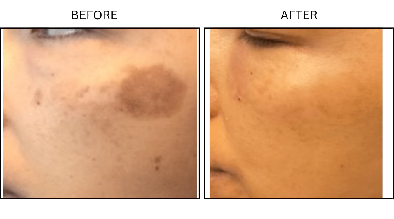 IPL (Lasers), before and after photograph 12