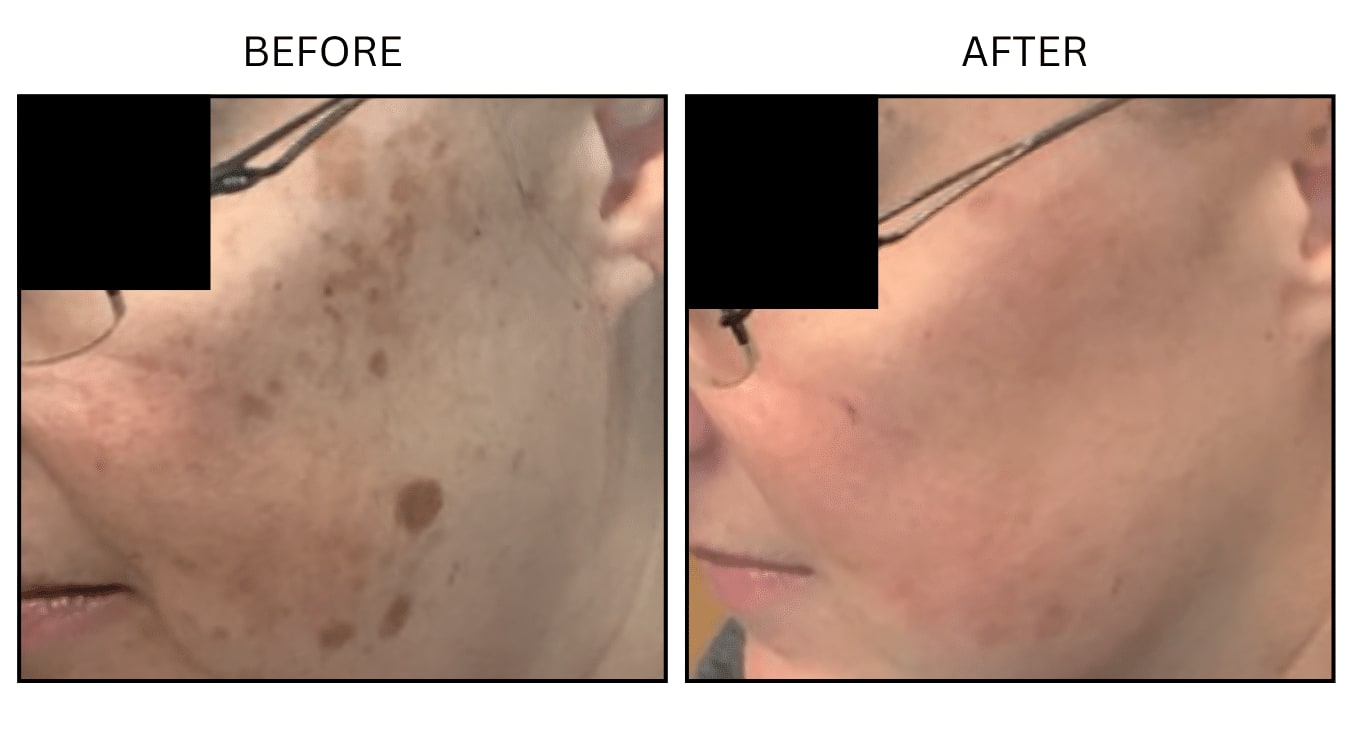IPL (Lasers), before and after photograph 18