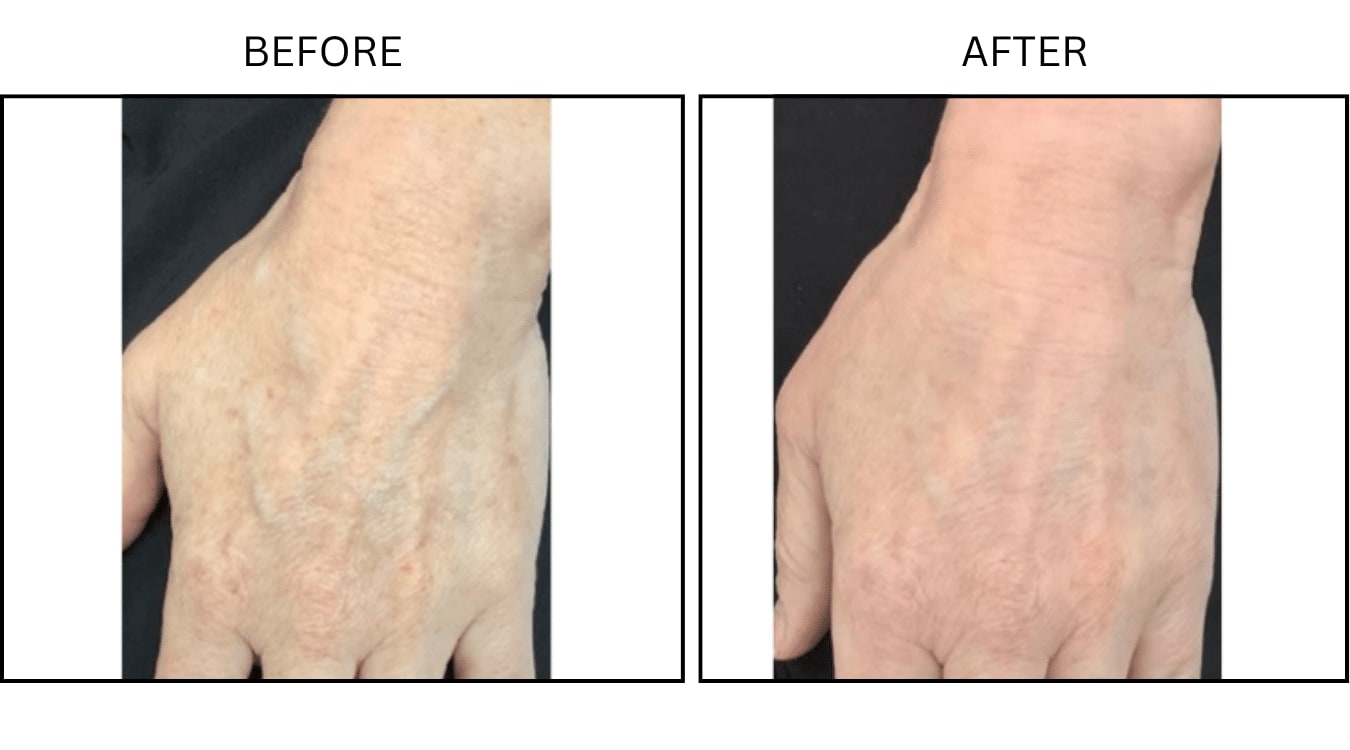 IPL (Lasers), before and after photograph 1
