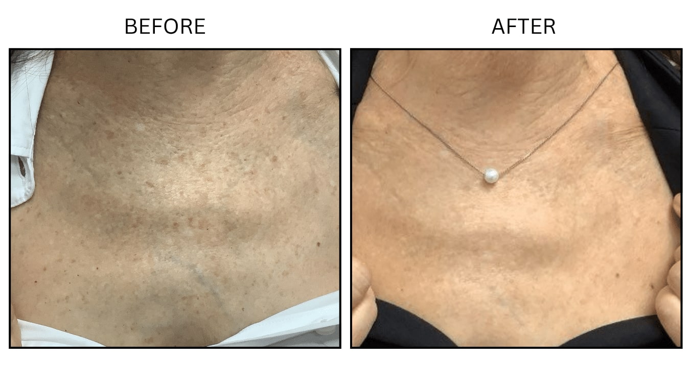 IPL (Lasers), before and after photograph 19
