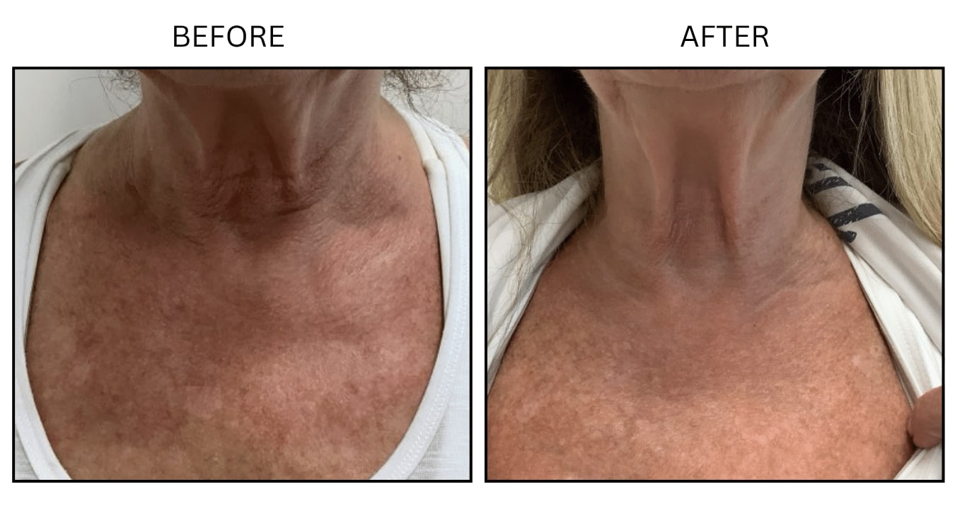 IPL (Lasers), before and after photograph 20