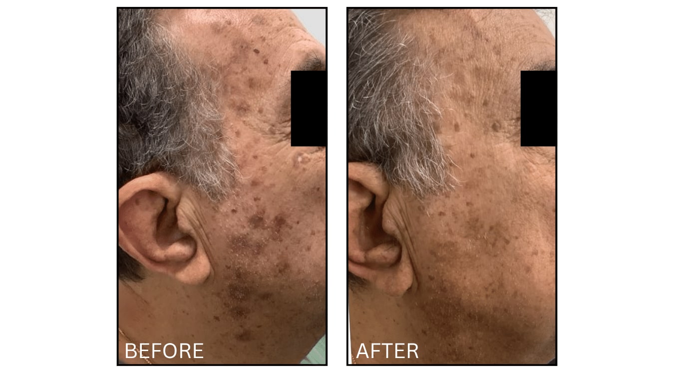 IPL (Lasers), before and after photograph 21