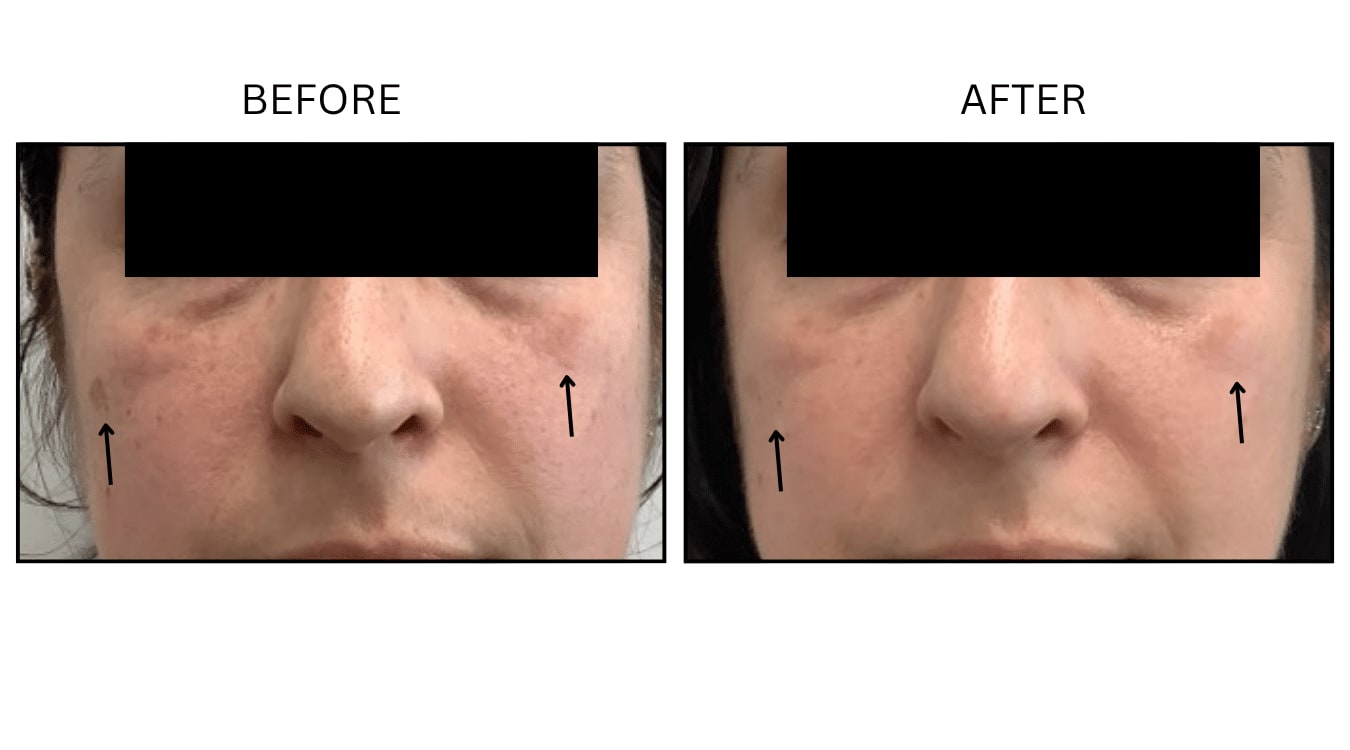 IPL (Lasers), before and after photograph 22