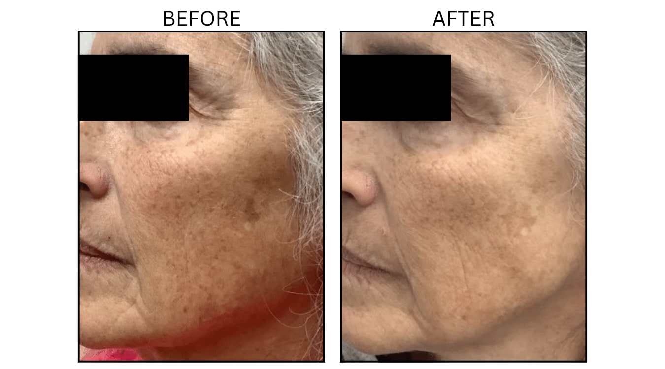 IPL (Lasers), before and after photograph 23