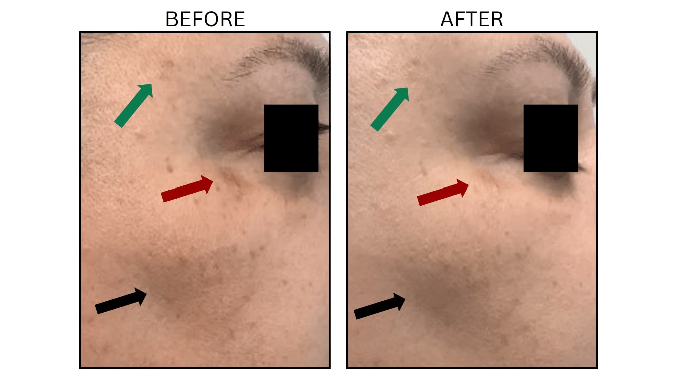 IPL (Lasers), before and after photograph 24