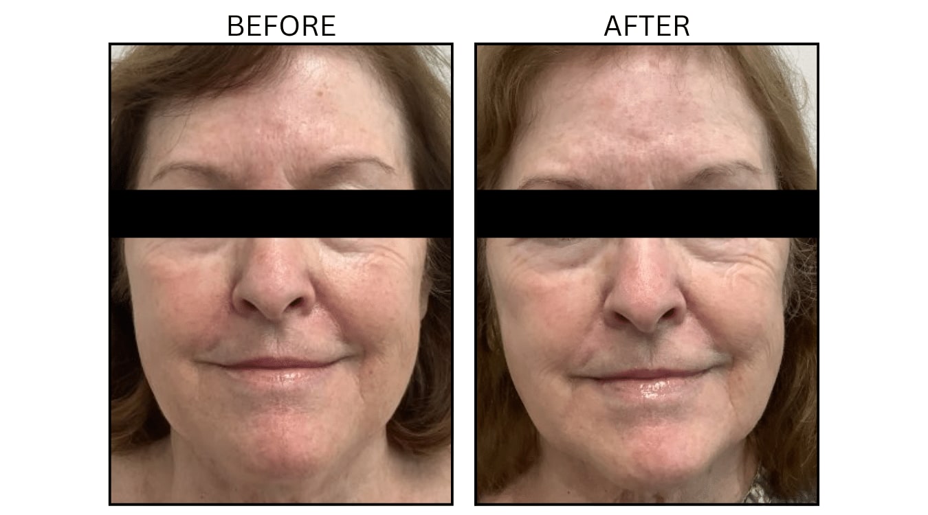 IPL (Lasers), before and after photograph 25