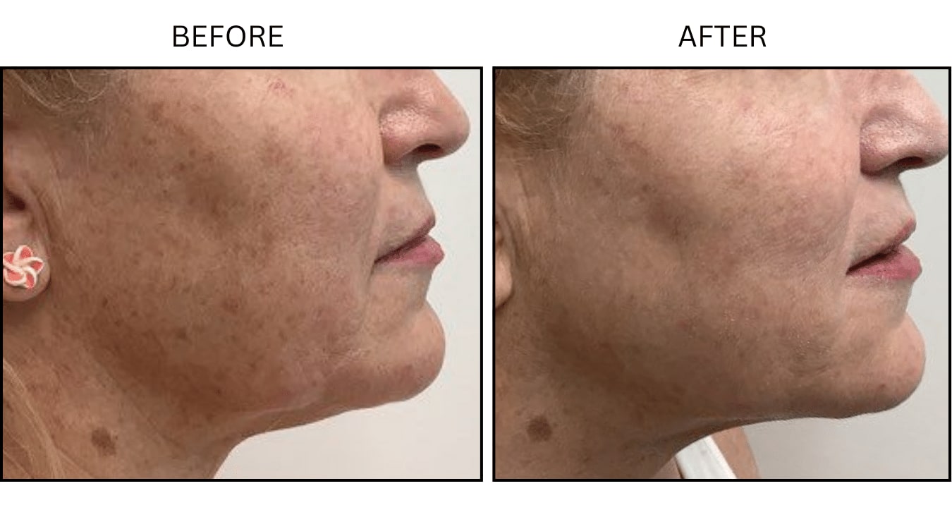 IPL (Lasers), before and after photograph 2