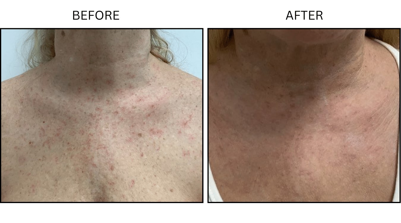 IPL (Lasers), before and after photograph 3