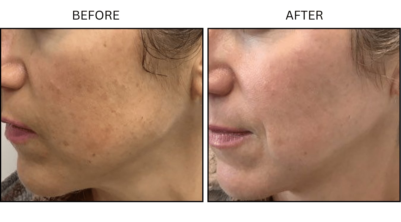 IPL (Lasers), before and after photograph 4
