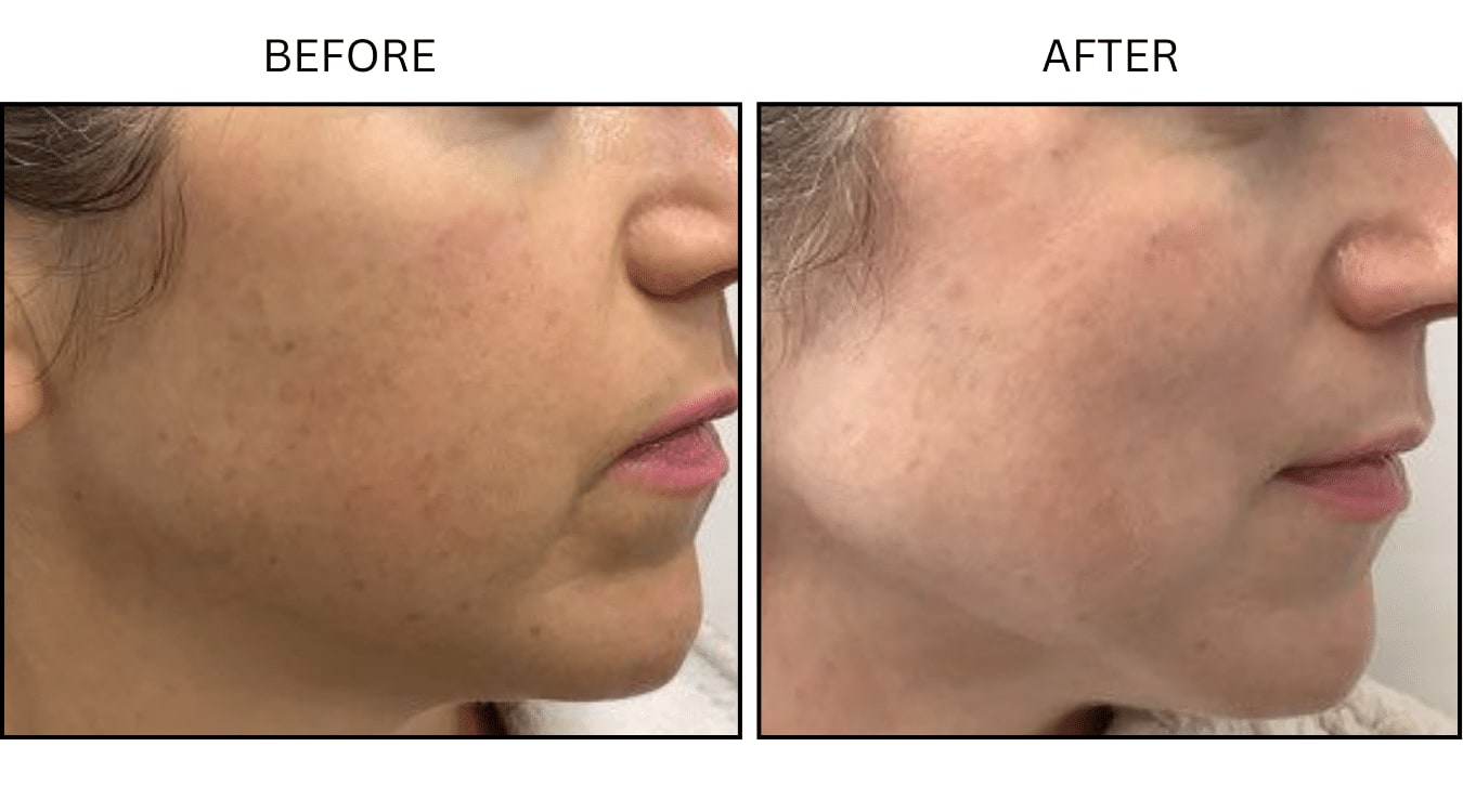 IPL (Lasers), before and after photograph 5