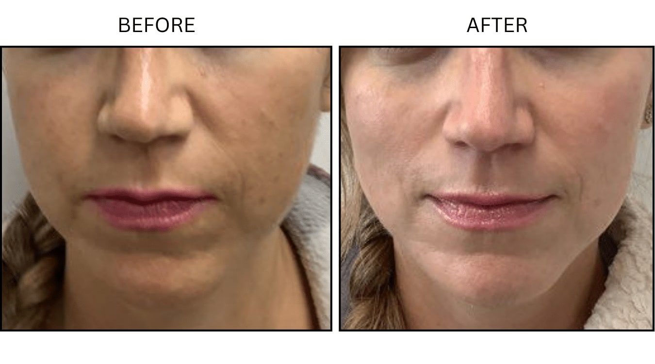 IPL (Lasers), before and after photograph 6