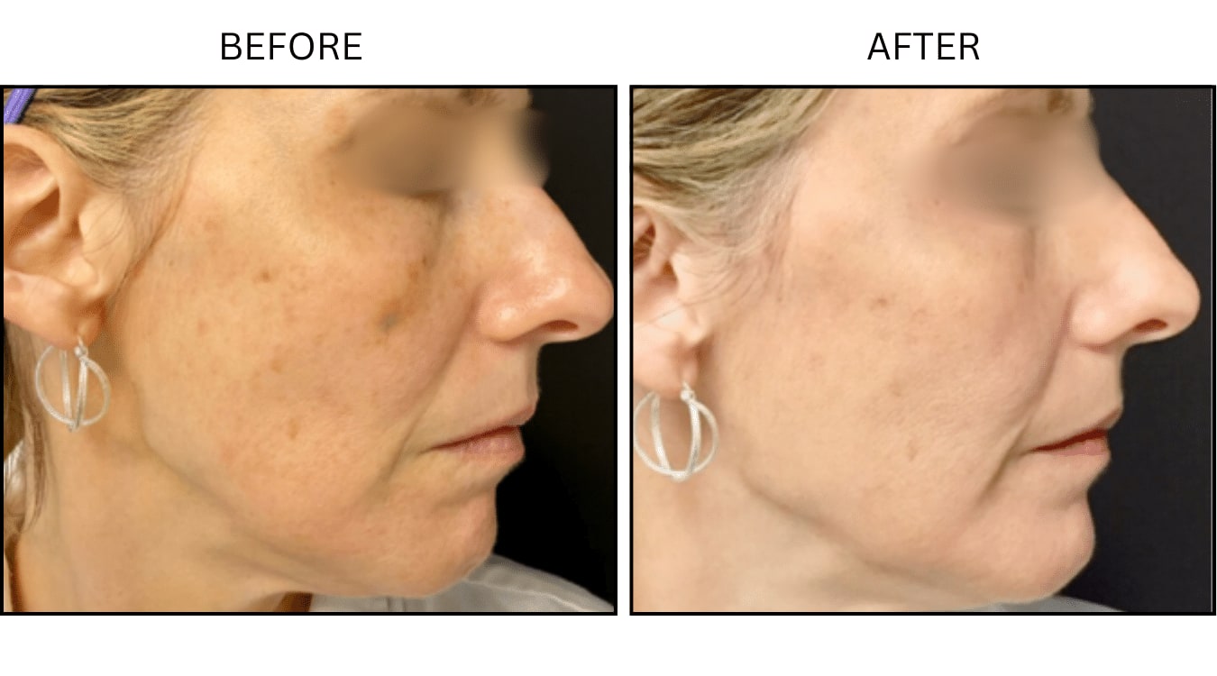 IPL (Lasers), before and after photograph 7
