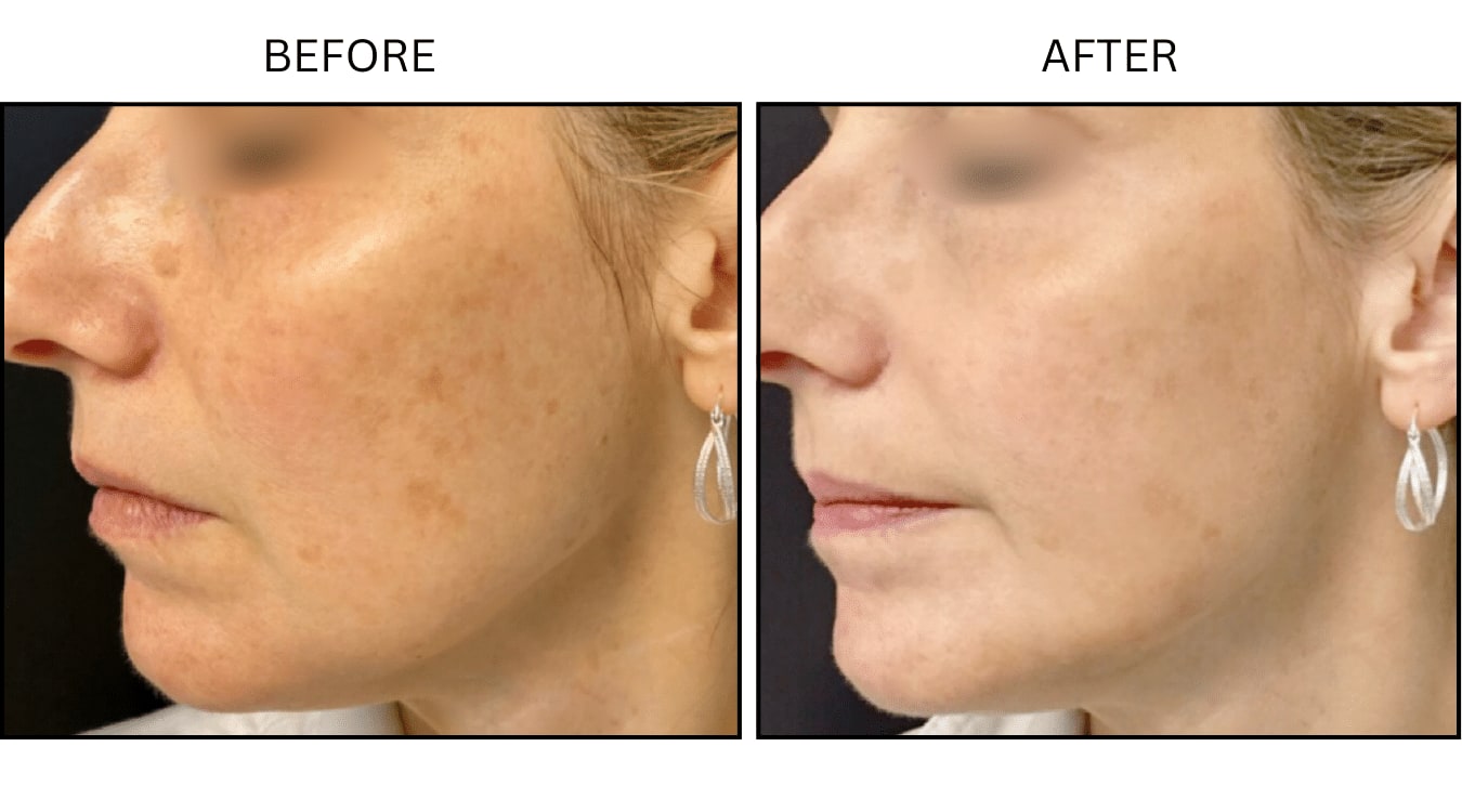 IPL (Lasers), before and after photograph 8