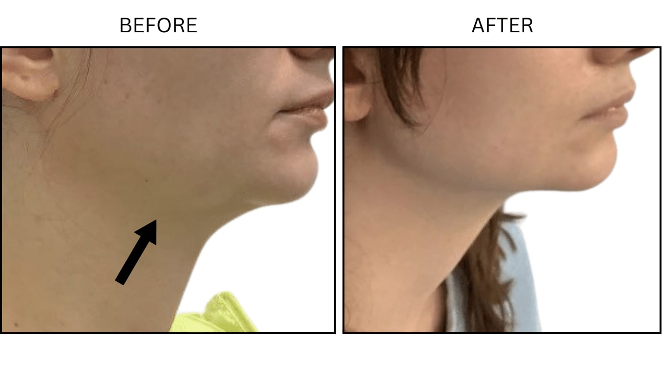 Jawline (Fillers), before and after photograph 2