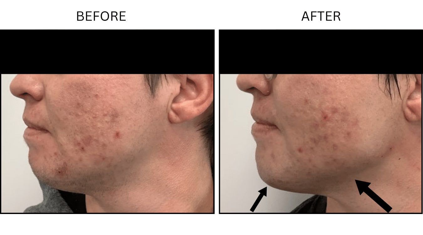 Jawline (Fillers), before and after photograph 3
