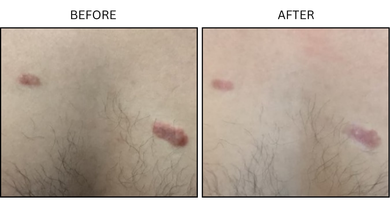 Keloids (Surgical (benign Destruction)), before and after photograph 1
