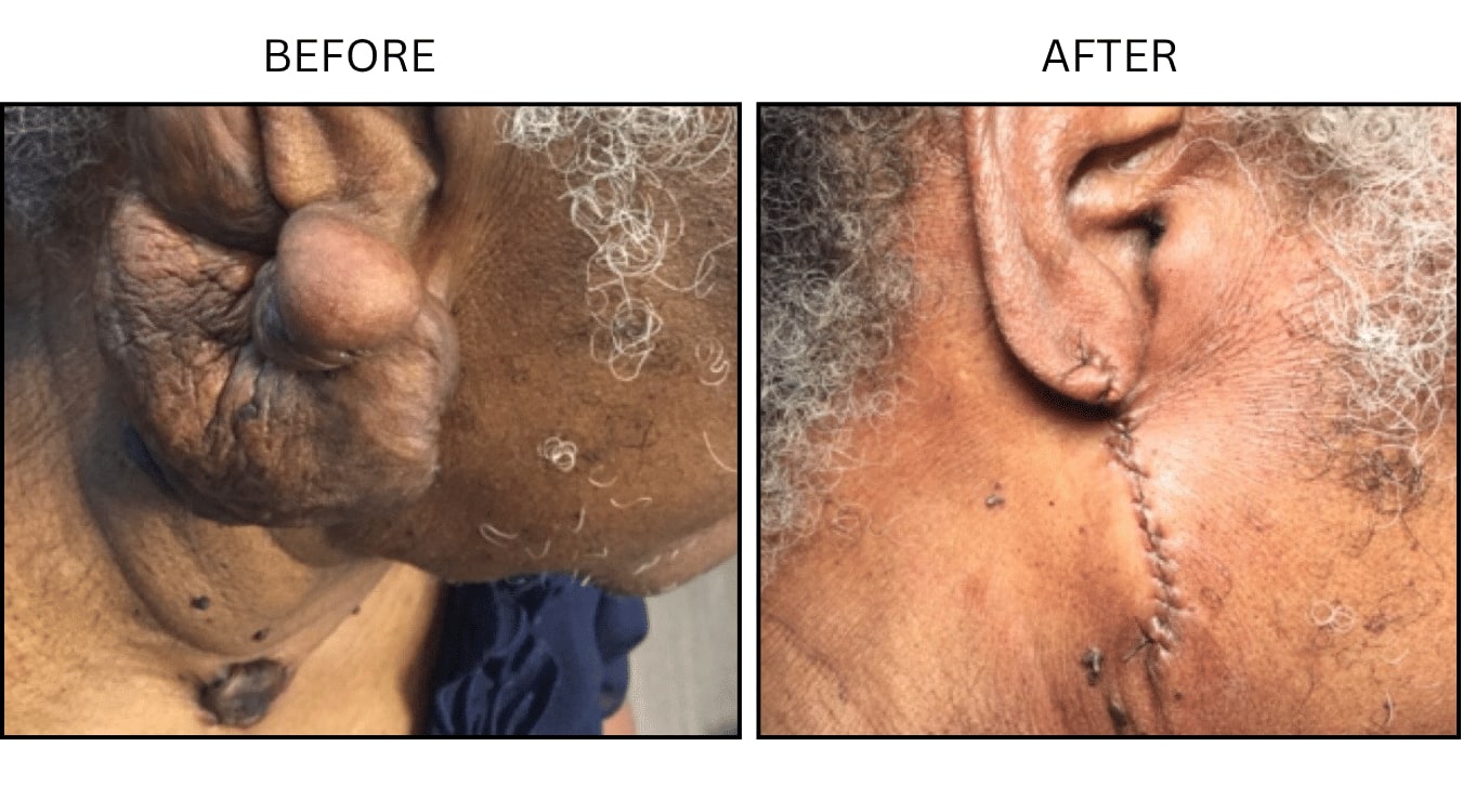 Keloids (Surgical (benign Destruction)), before and after photograph 12