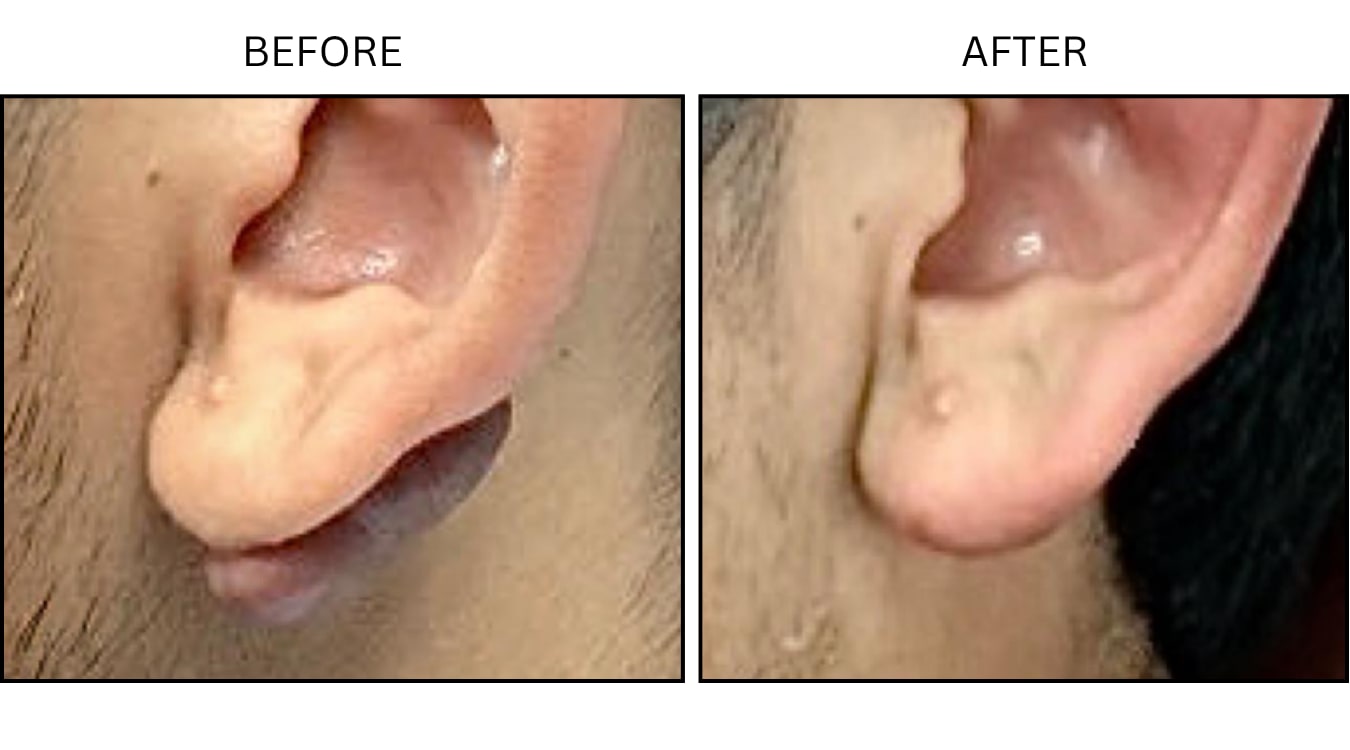 Keloids (Surgical (benign Destruction)), before and after photograph 2