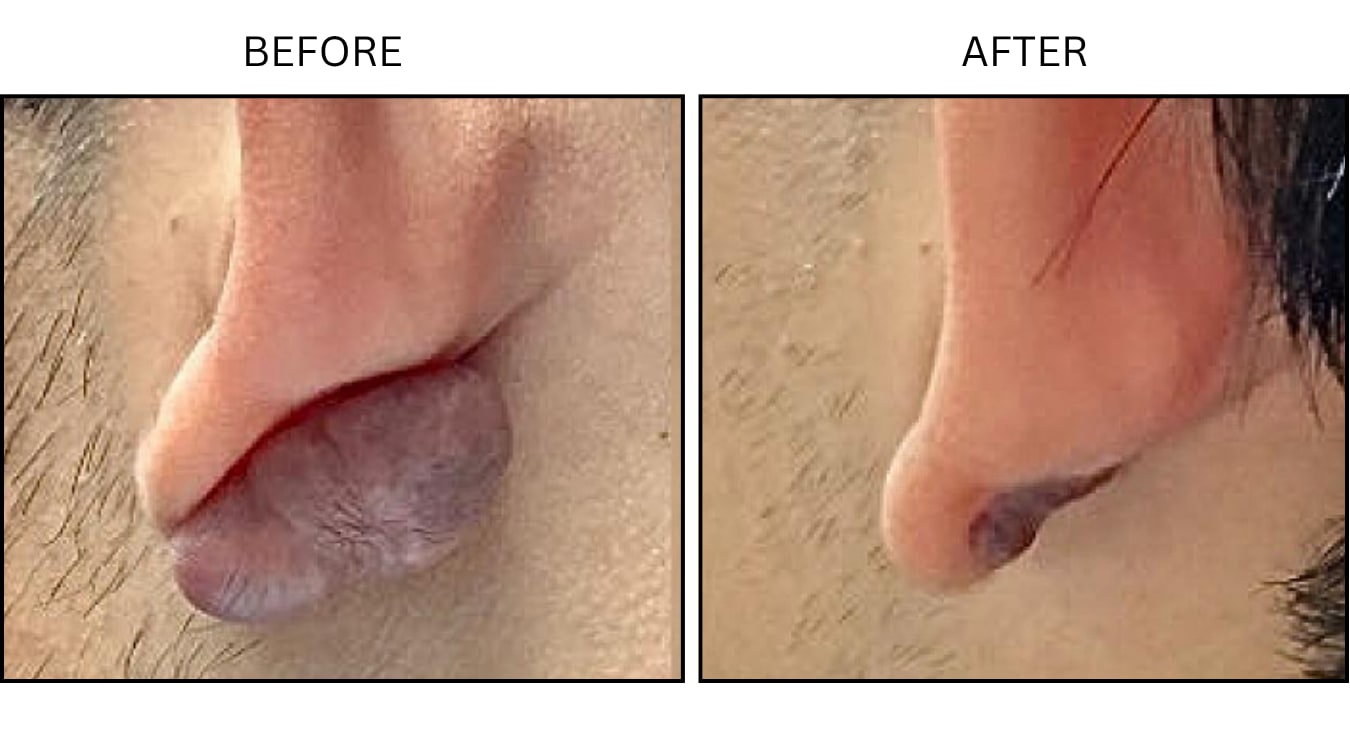 Keloids (Surgical (benign Destruction)), before and after photograph 3