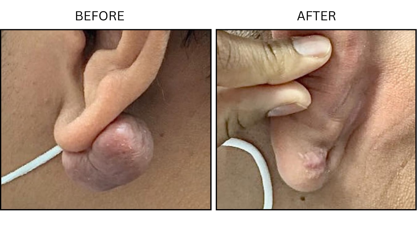Keloids (Surgical (benign Destruction)), before and after photograph 4