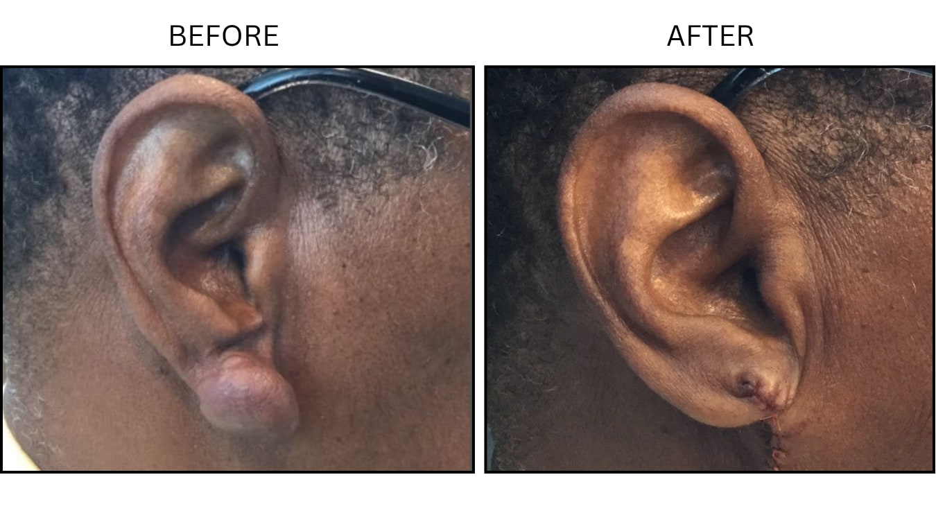 Keloids (Surgical (benign Destruction)), before and after photograph 5