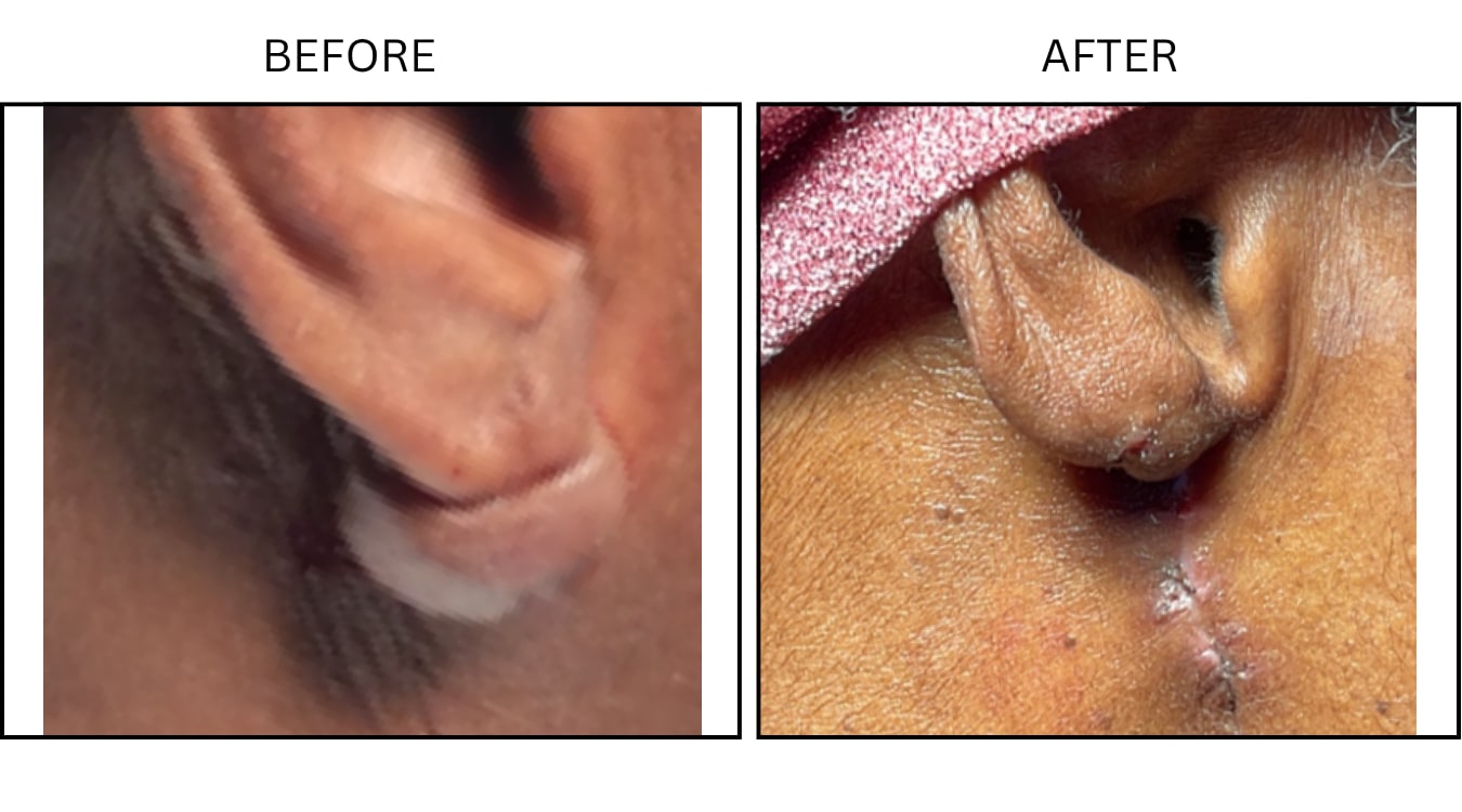 Keloids (Surgical (benign Destruction)), before and after photograph 6