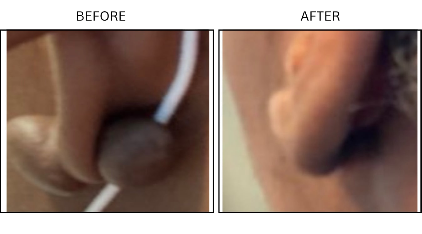 Keloids (Surgical (benign Destruction)), before and after photograph 7