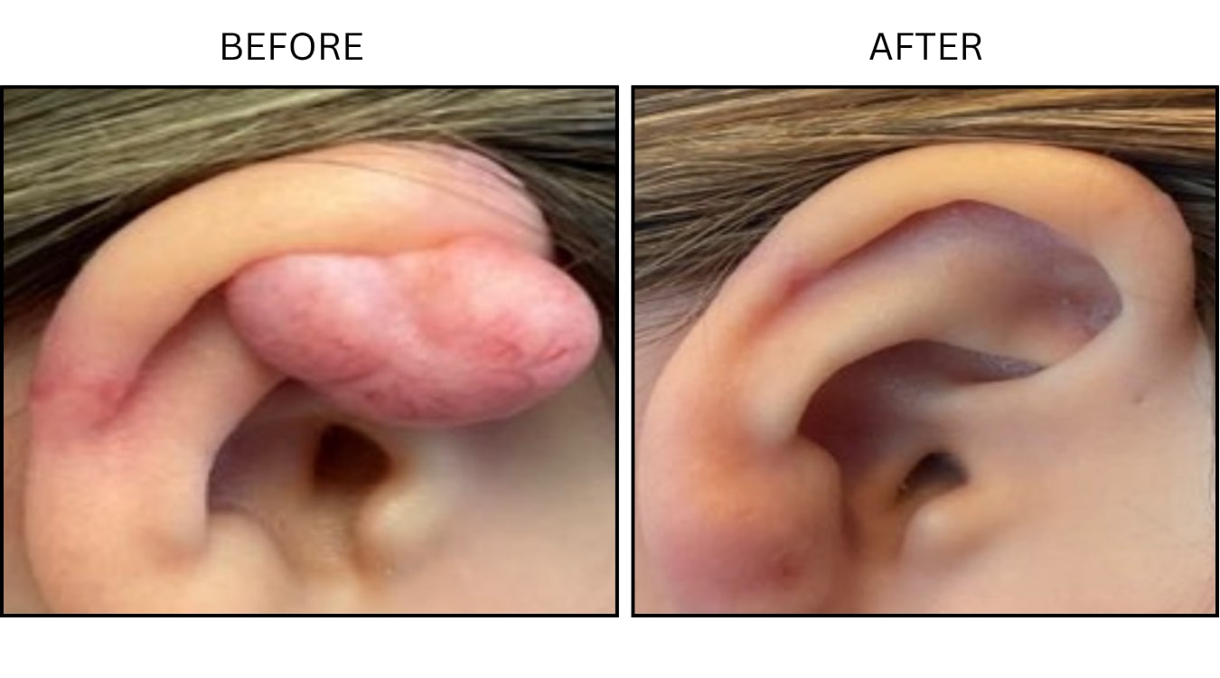 Keloids (Surgical (benign Destruction)), before and after photograph 8