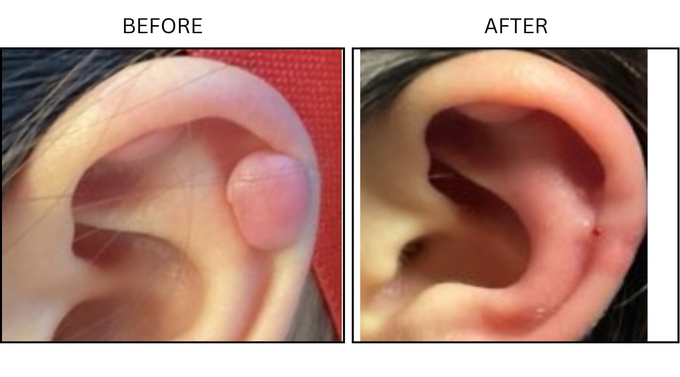Keloids (Surgical (benign Destruction)), before and after photograph 9