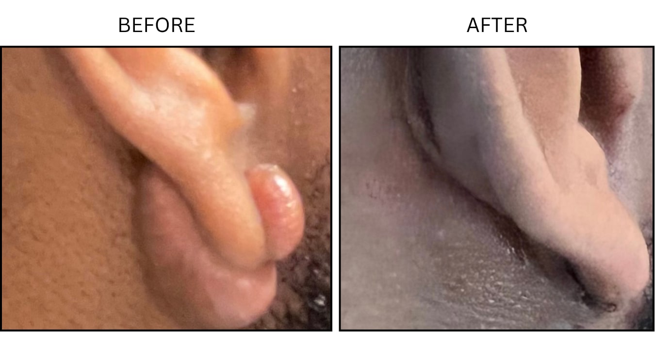 Keloids (Surgical (benign Destruction)), before and after photograph 10
